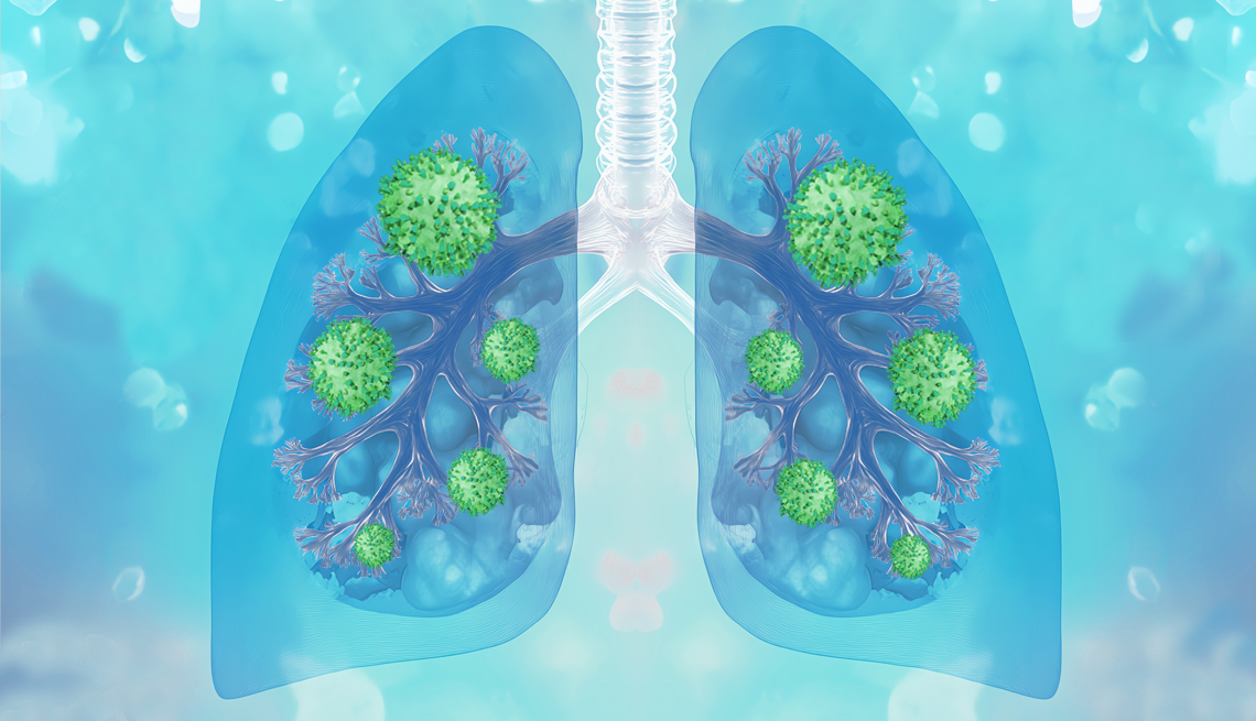 Ilustración de unos pulmones enfermos