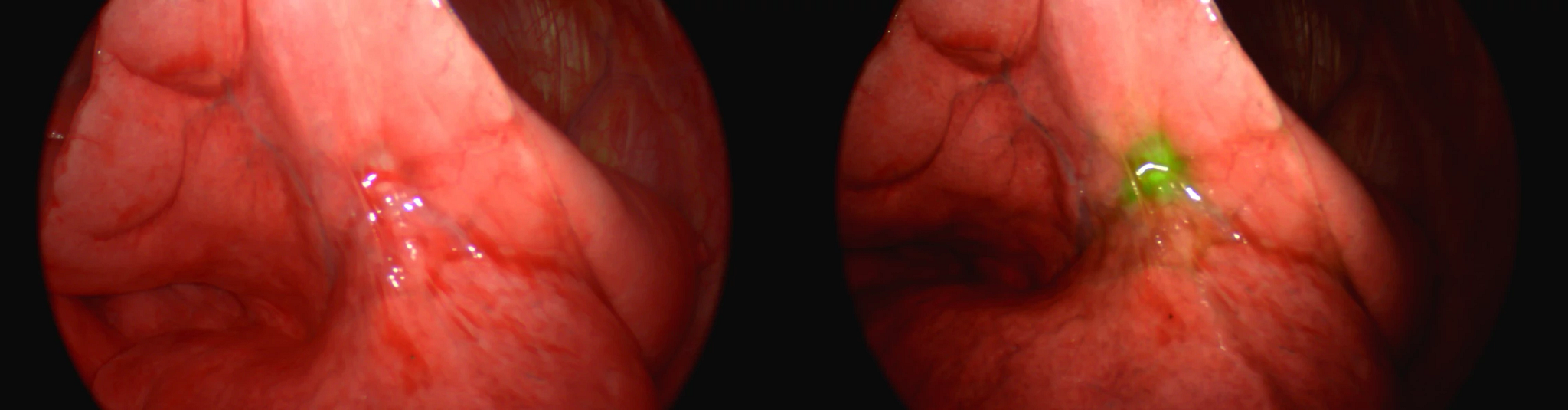 Surgical Still side by side of lung