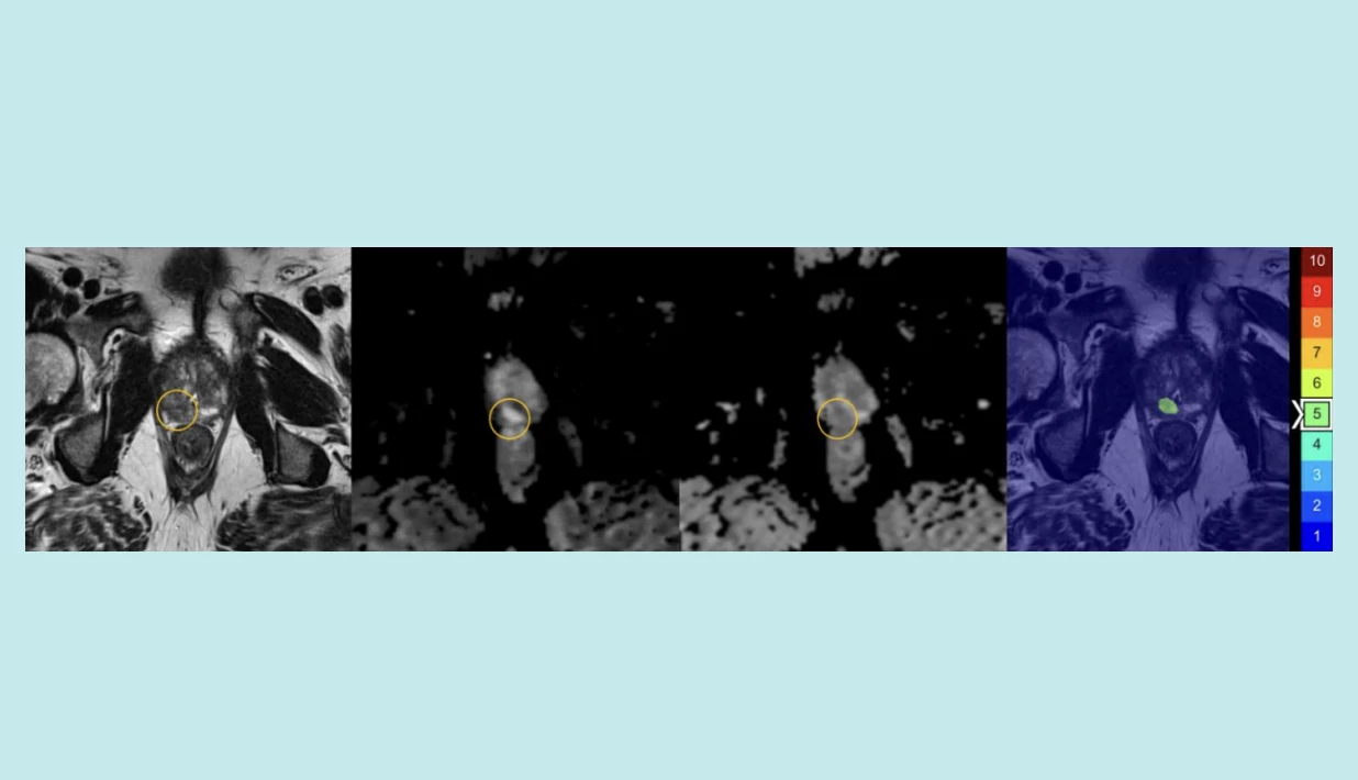 AI-assisted upgrading in the assessment