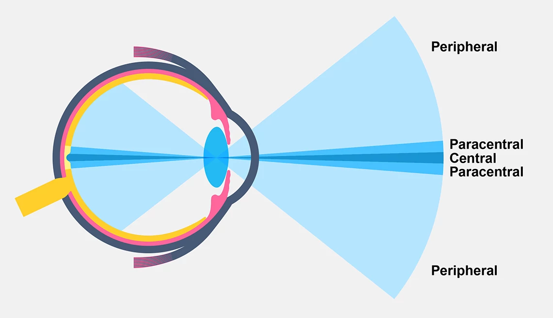 Peripheral vision loss impacts the sides and top and bottom of your vision. a diagram showing peripheral and central vision