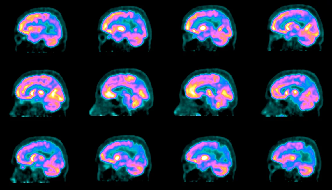 Escáner cerebral de una persona con Alzheimer