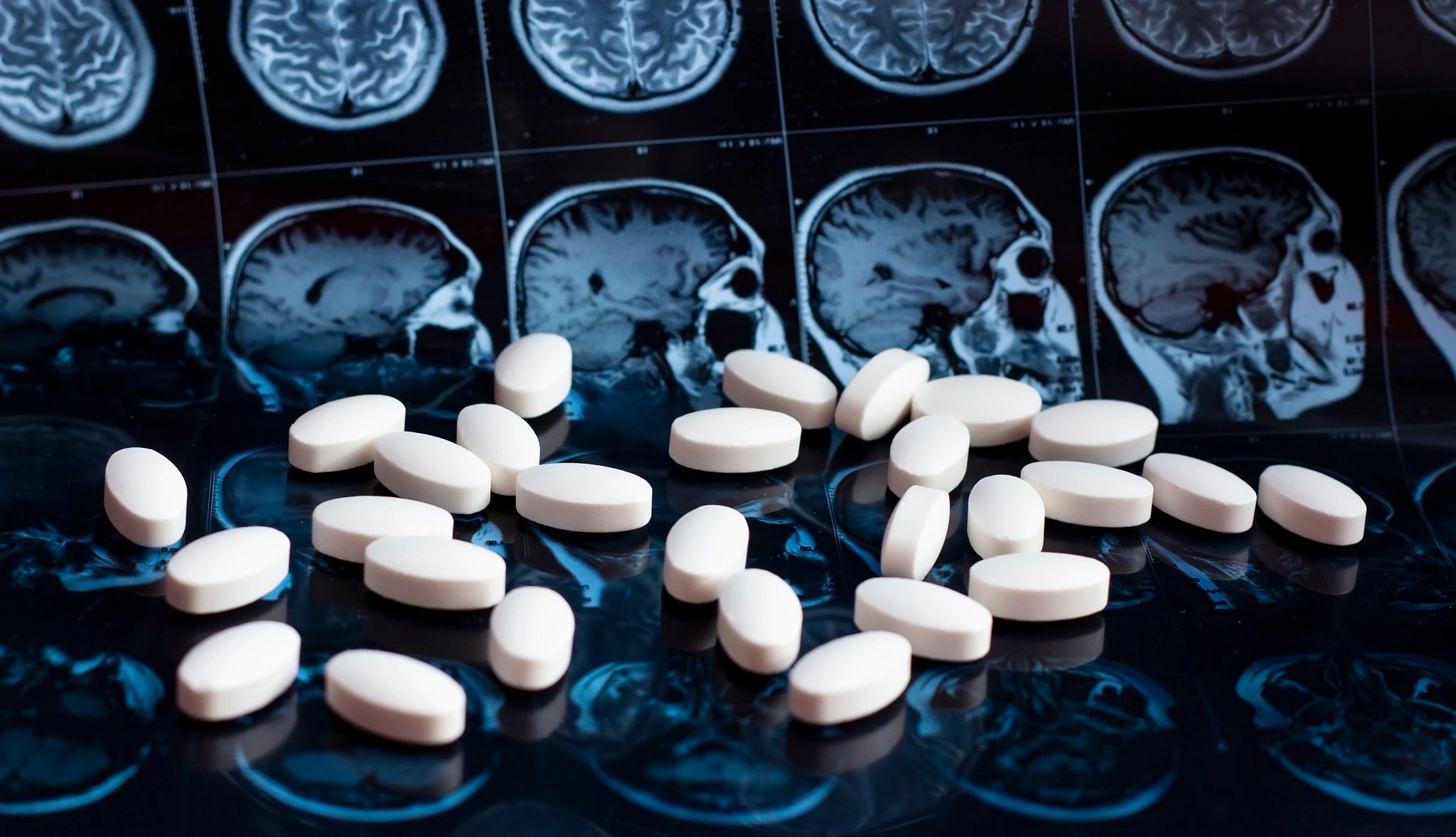 What Are the Treatments for Alzheimer's Disease?