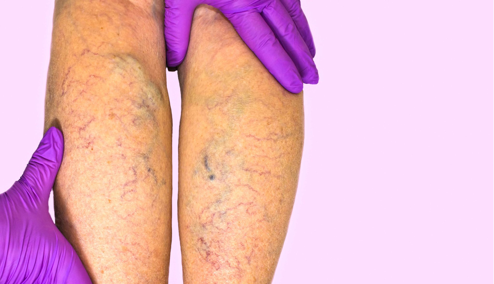 10 Things to Know About Chronic Venous Insufficiency veins in a leg