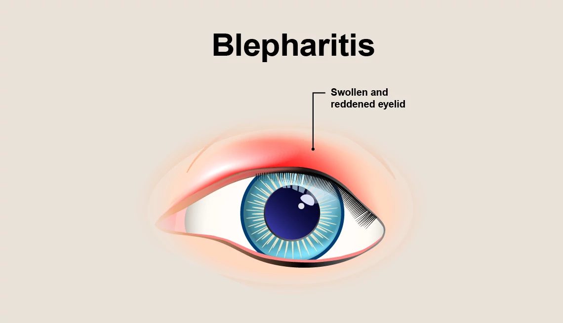 illustration of blepharitis