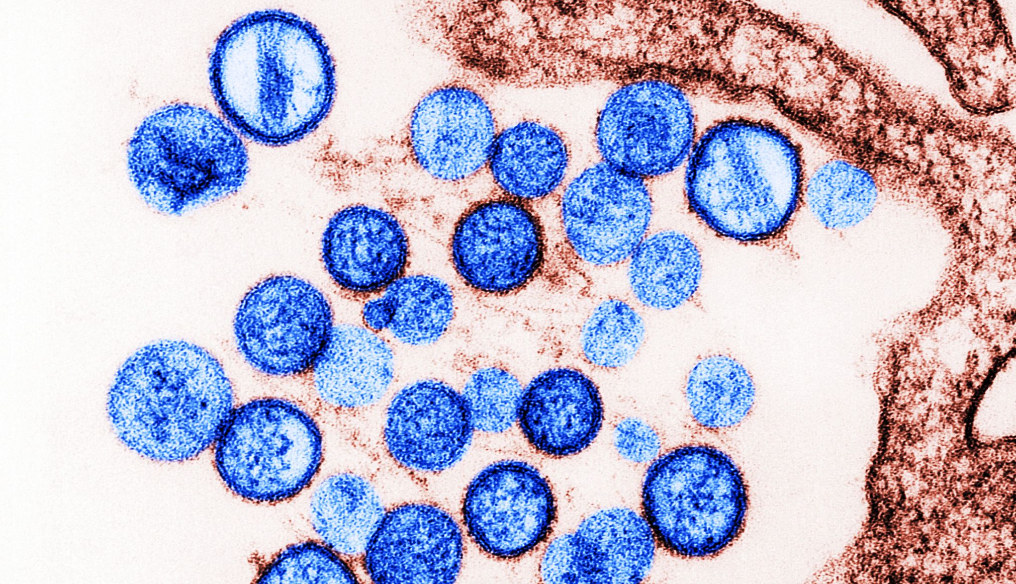 8 Hantavirus Questions, Answered