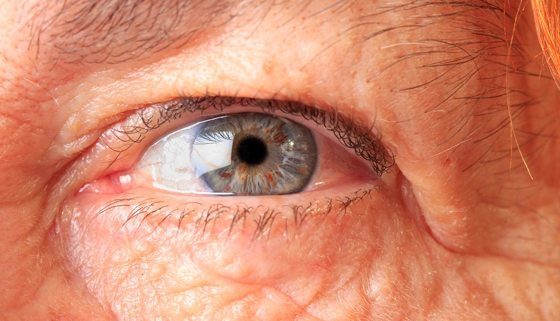 woman with watery eyes