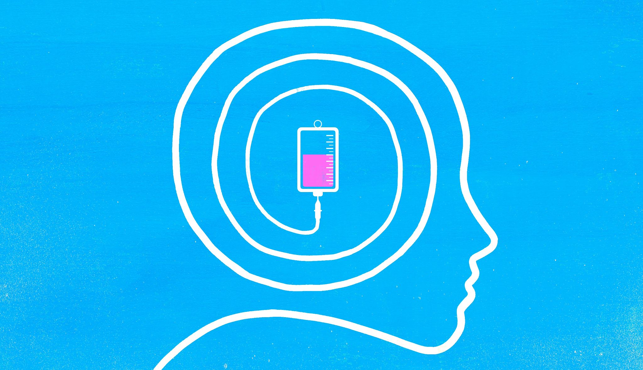 Leqembi and Kisunla are two medications that may be able to slow the progression of Alzheimer's disease An illustration of the outline of a person's head connecting to an IV bag in the middle of it