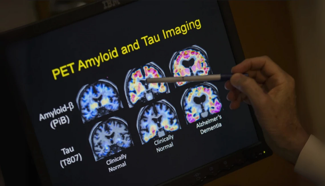 A doctor points to PET scan results that are part of a study on Alzheimer’s disease