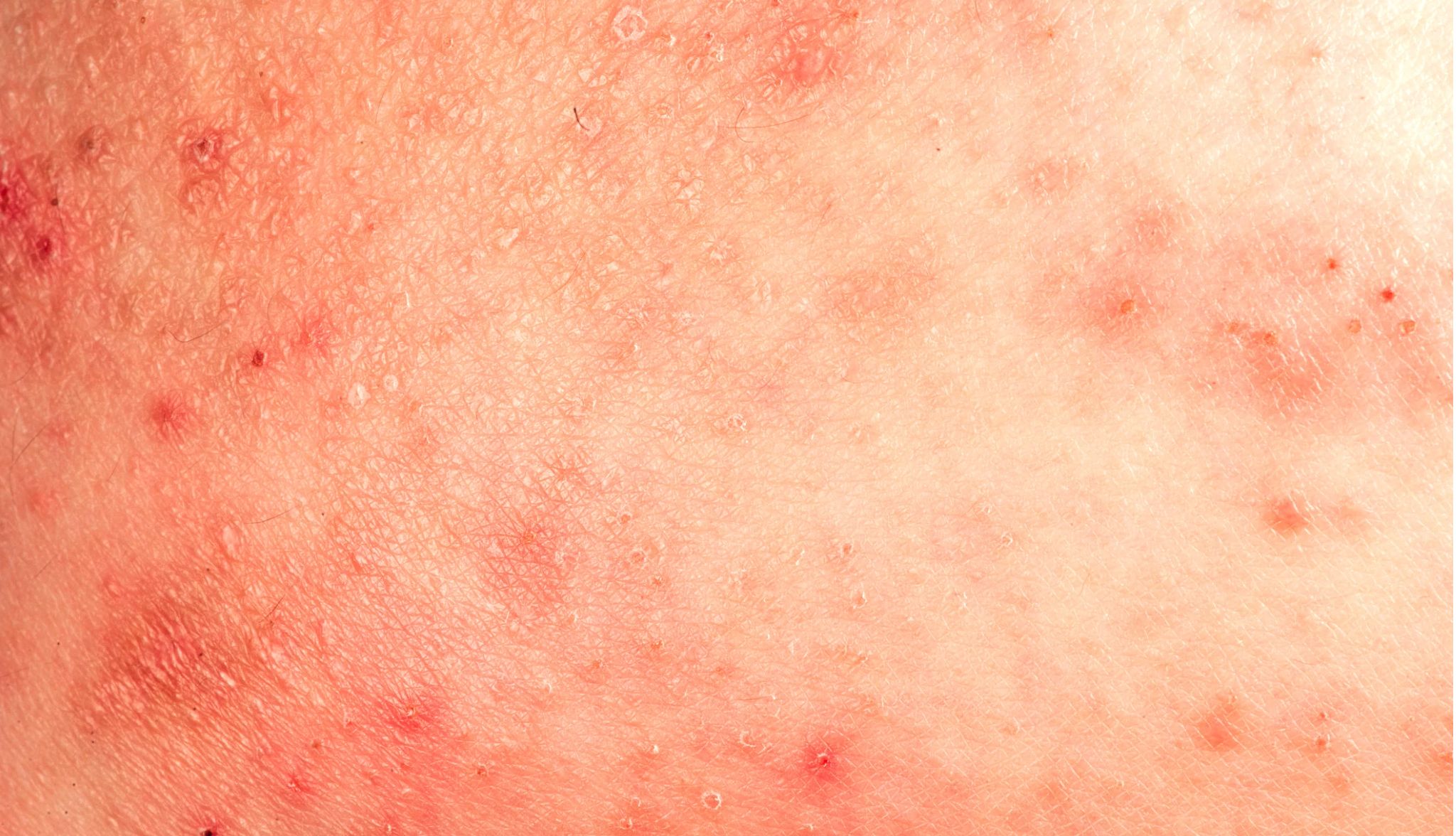 Asteatotic eczema 
