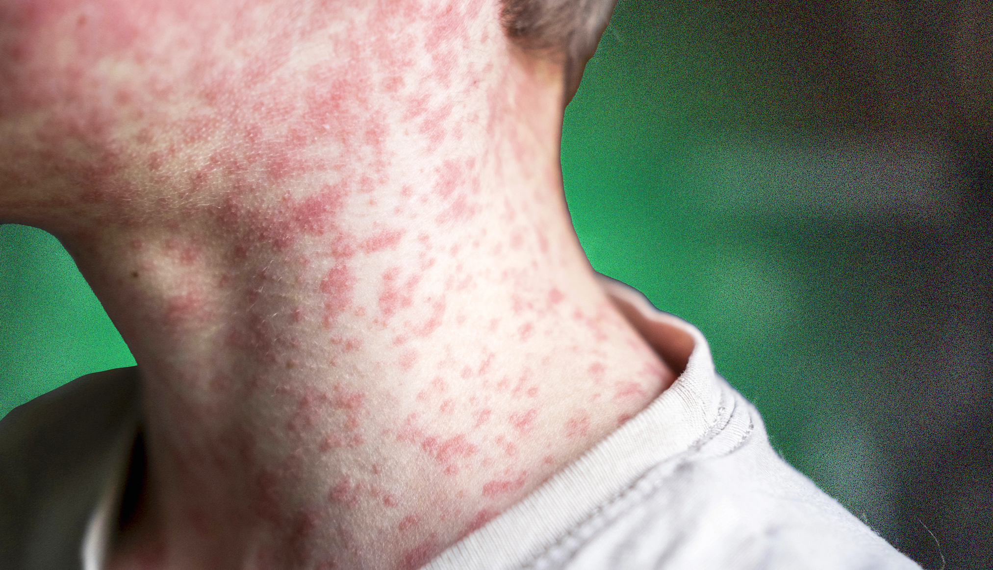 What to Know About Measles measles rash