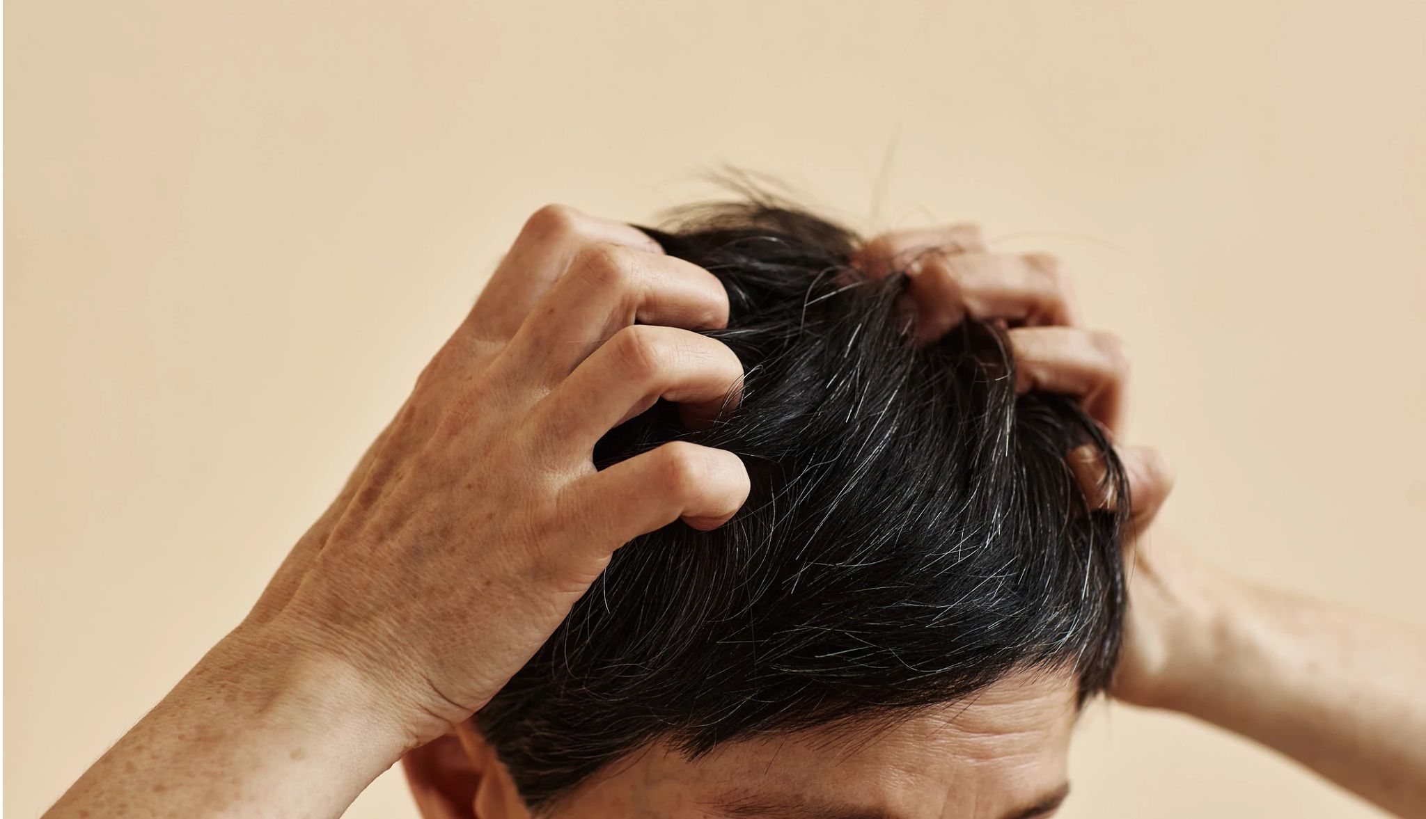 Man Scratching His Itchy Scalp man scratching the top of his head with both hands