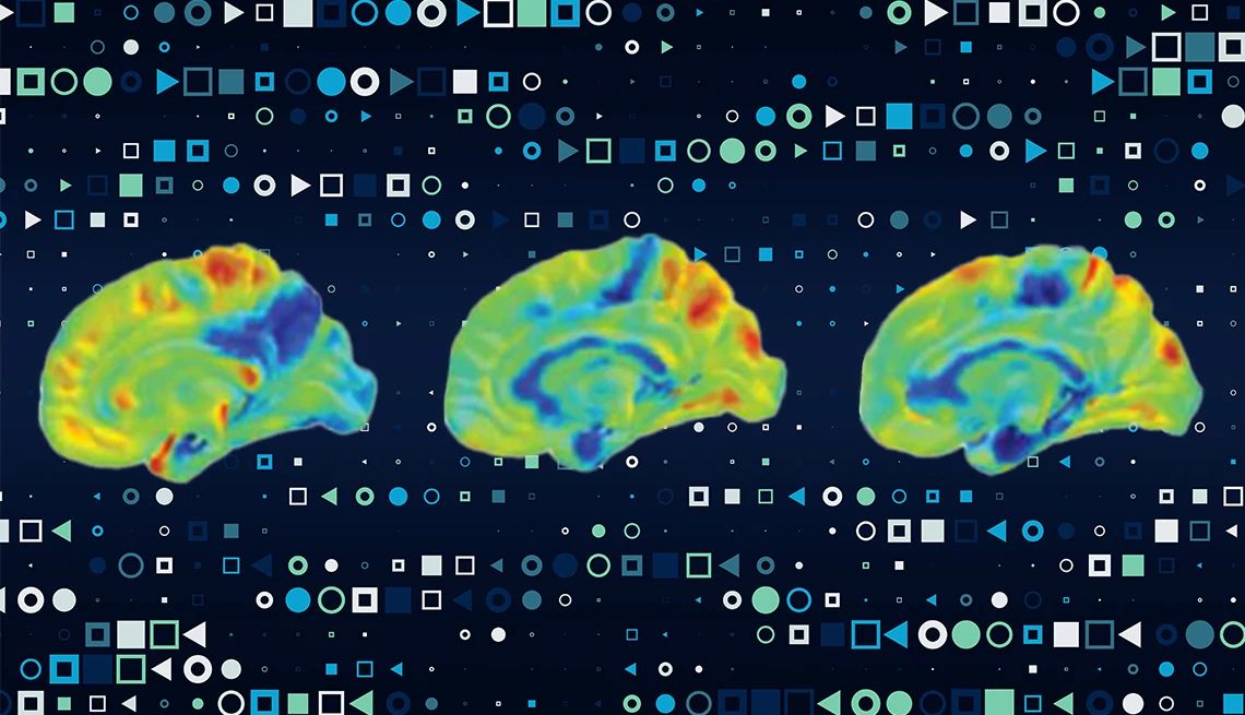 Inteligencia artificial detecta tipos de demencia Imagen de una tomografía PET cerebral para diagnóstico de demencia