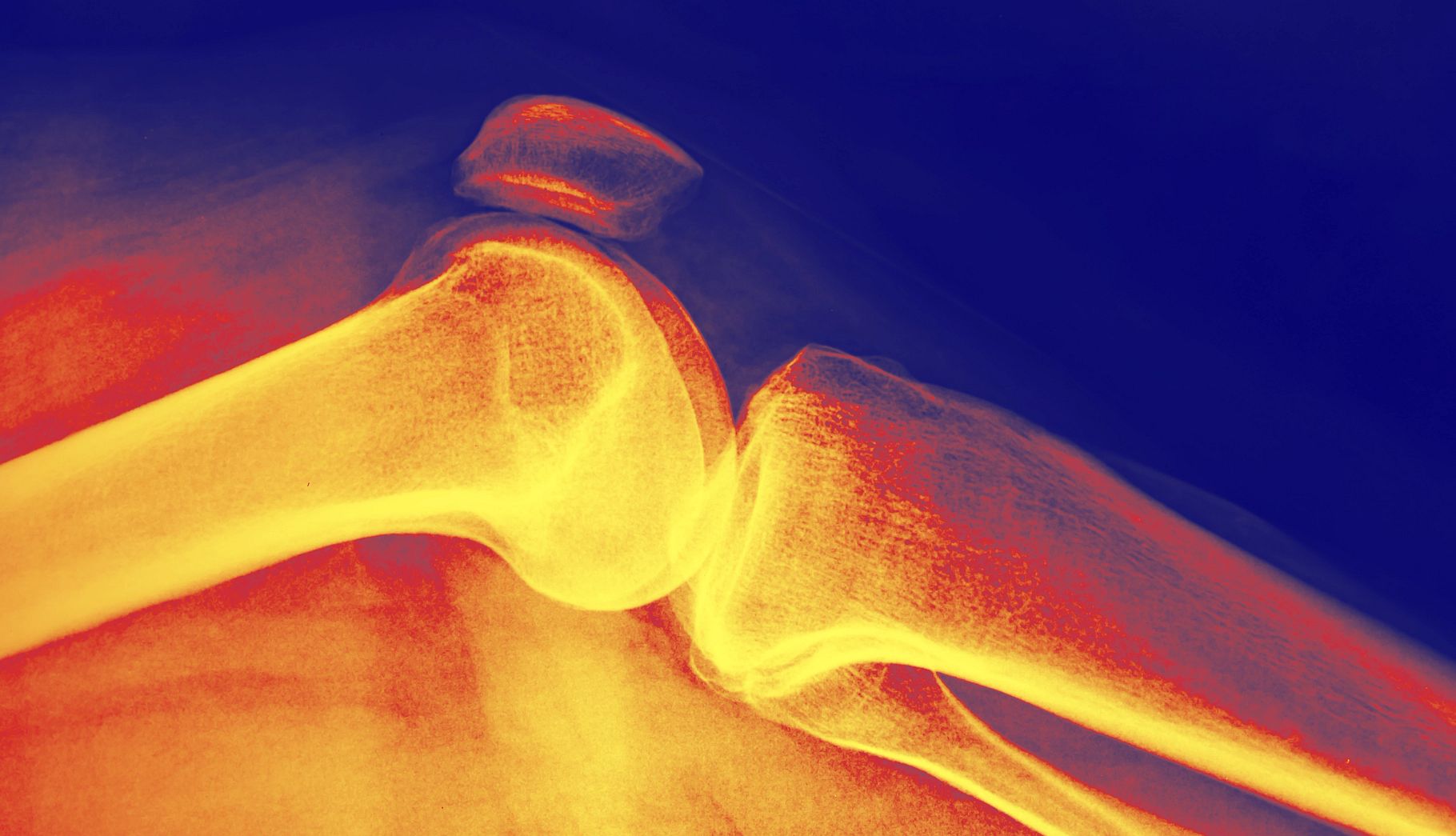 Understanding Inflammation: What It Is and Why It Matters for Your Health