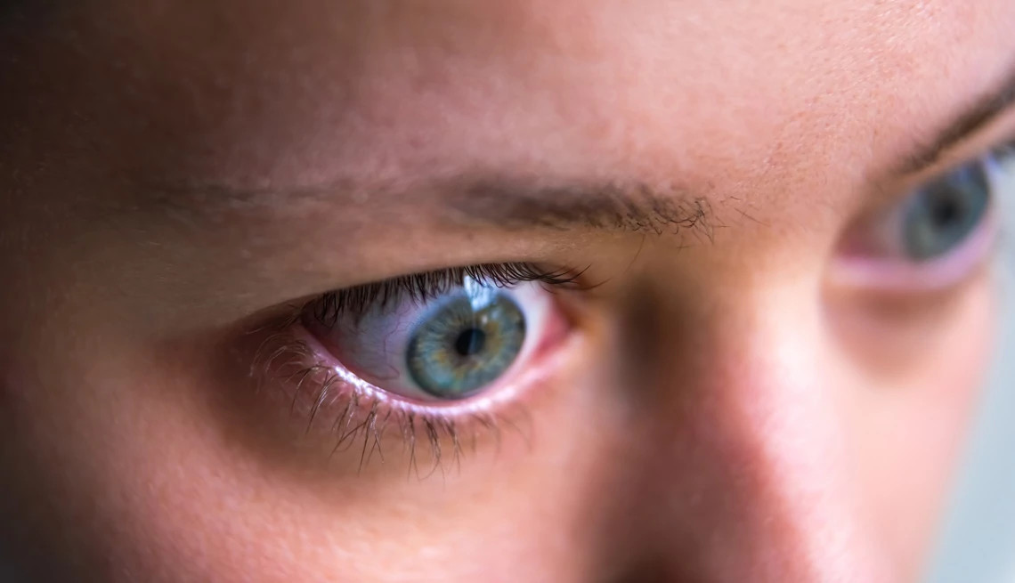 Closeup profile of a woman’s face with Grave's disease