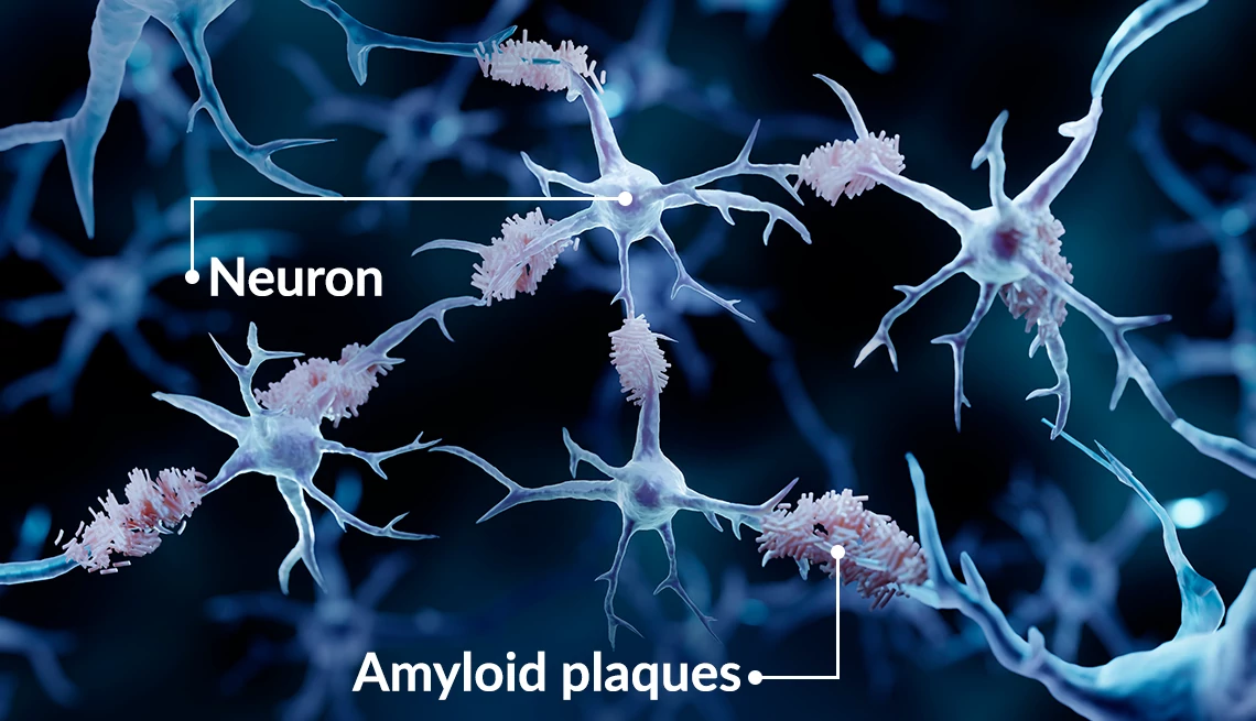 Ilustración de las placas amiloides