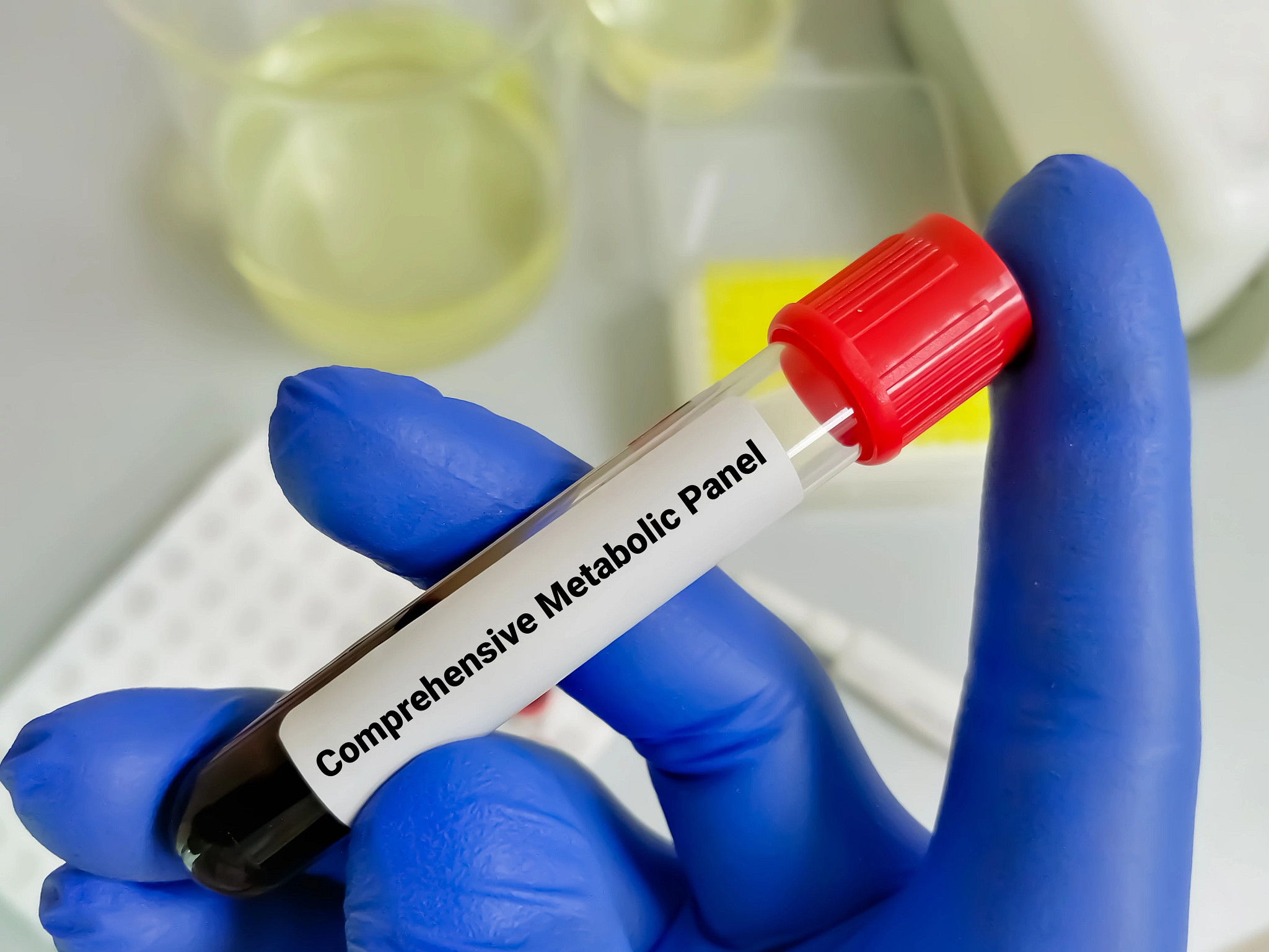 blood vial with a comprehensive metabolic panel label