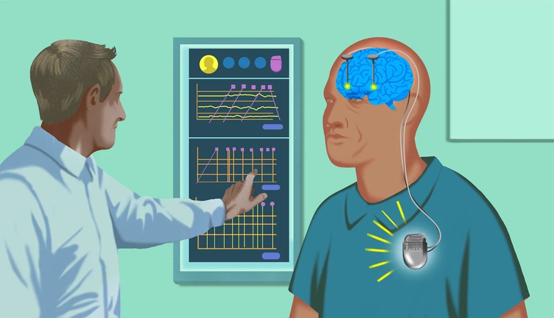 AI Parkinson's Treatment deep brain stimulation illustration