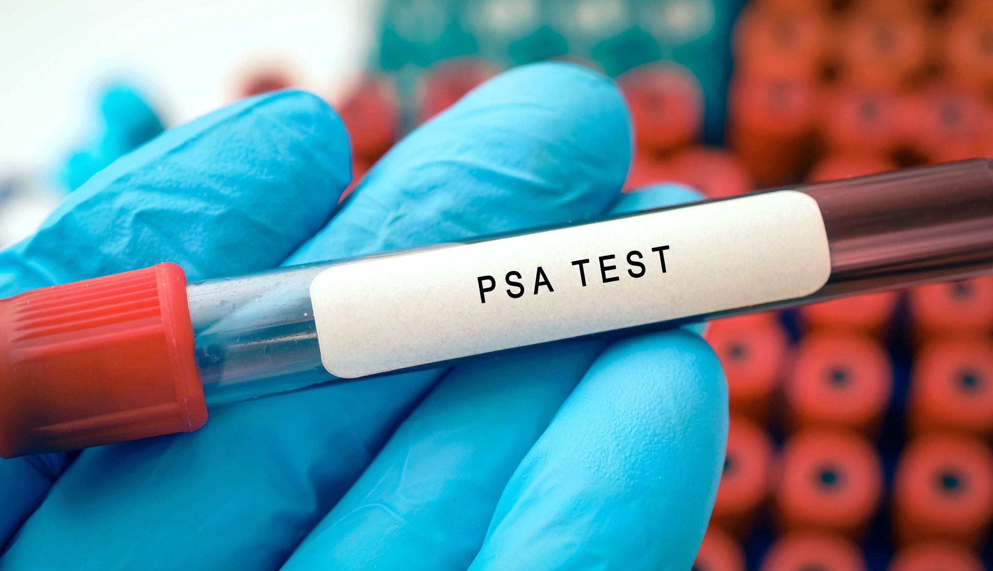 Prueba PSA de cáncer de próstata: ¿debo hacérmela? Prueba de sangre para medir PSA en detección de cáncer de próstata