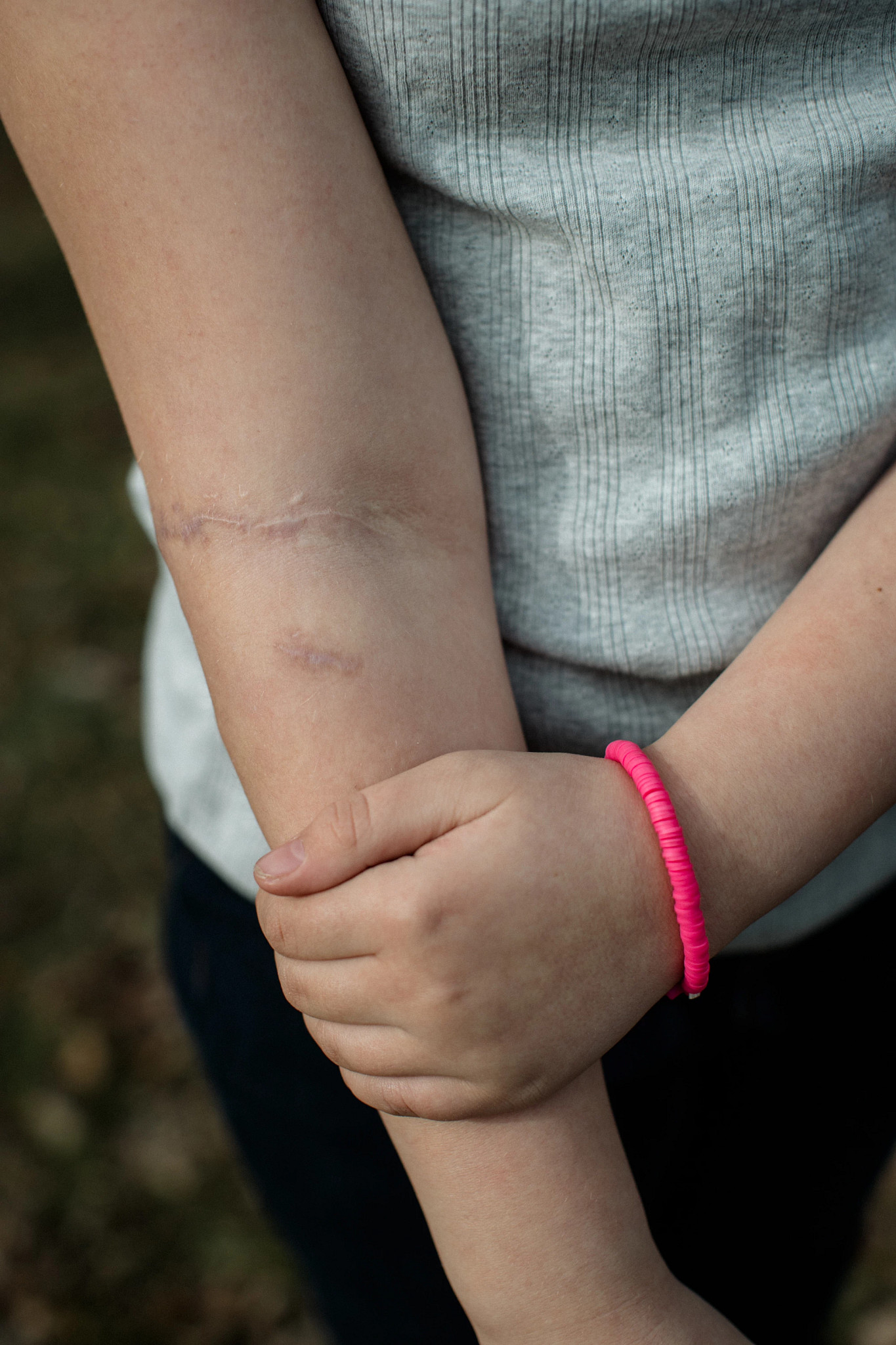 Chloe Shanks shows the scar she suffered in a dog attack