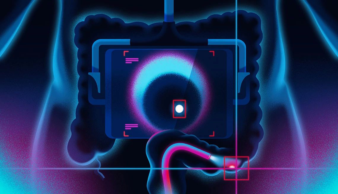 Breakthroughs in Colon Cancer Screening digital illustration of a colon cancer screening