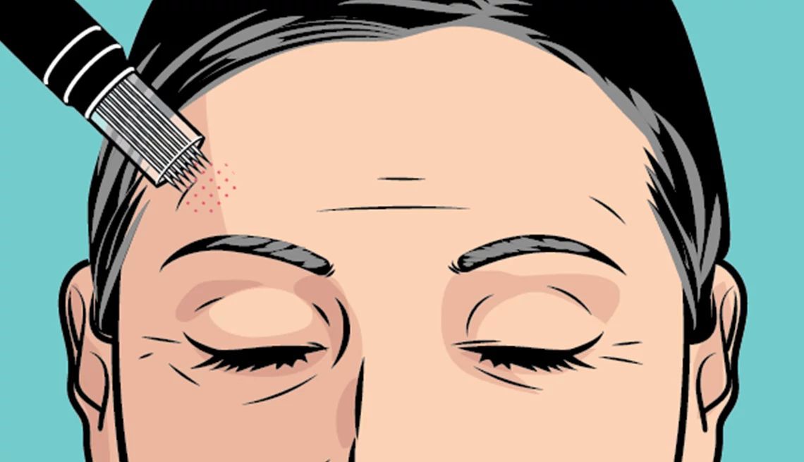 Microneedling Microneedling
