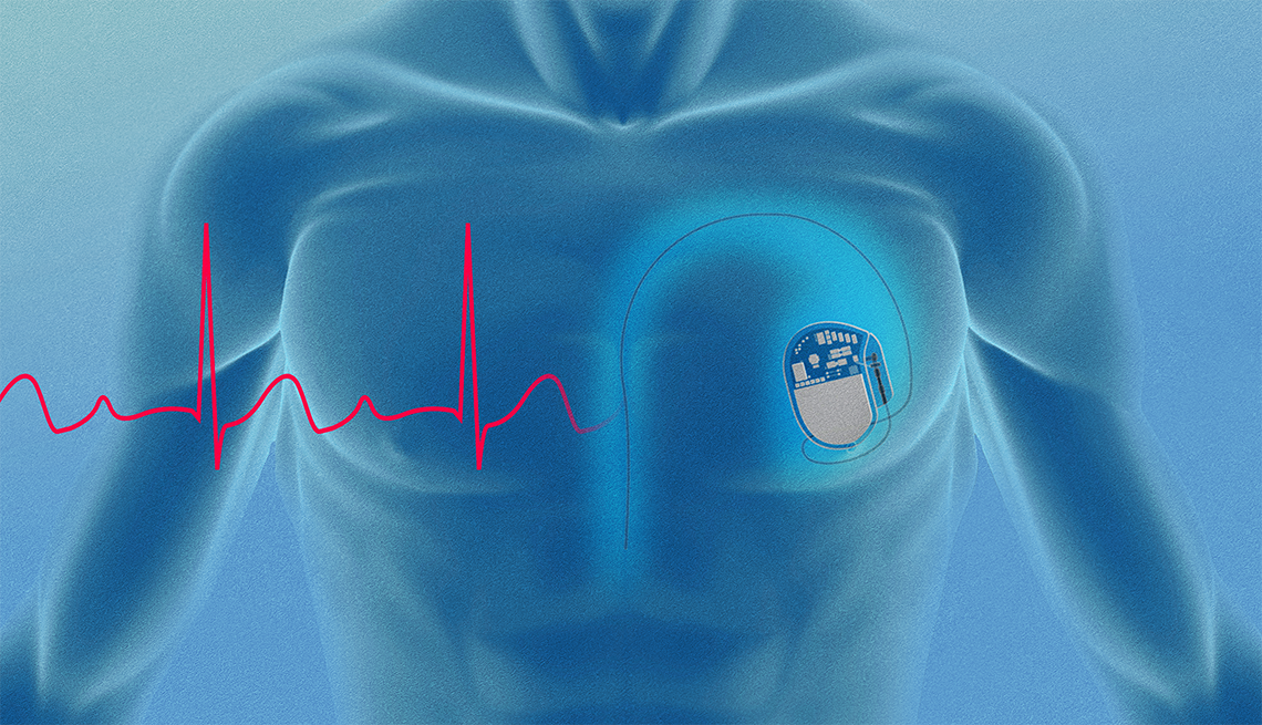 digital illustration of a chest with a pacemaker and heart rate