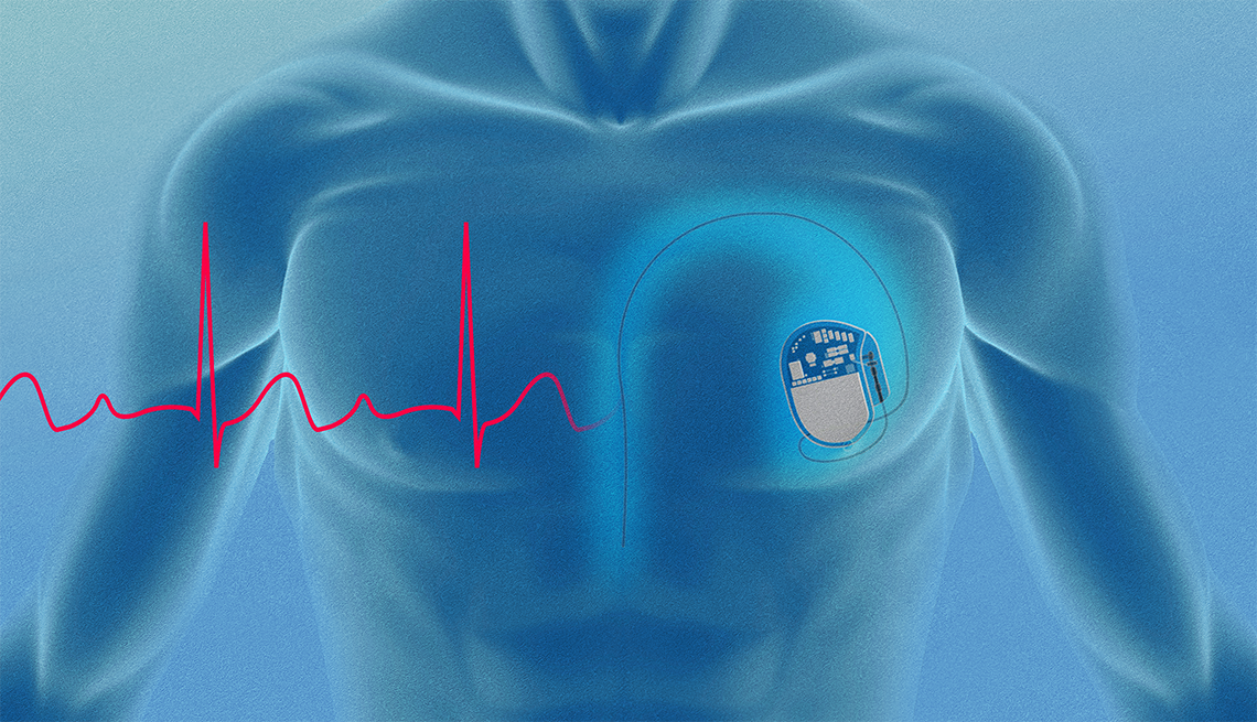 What to Know About Pacemakers digital illustration of a chest with a pacemaker and heart rate
